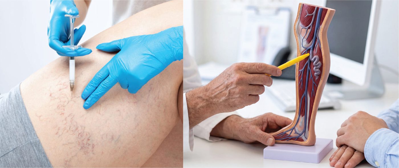 Sclerotherapy injection and a doctor explaining vein anatomy